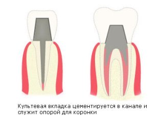 Культевая вкладка на зубы