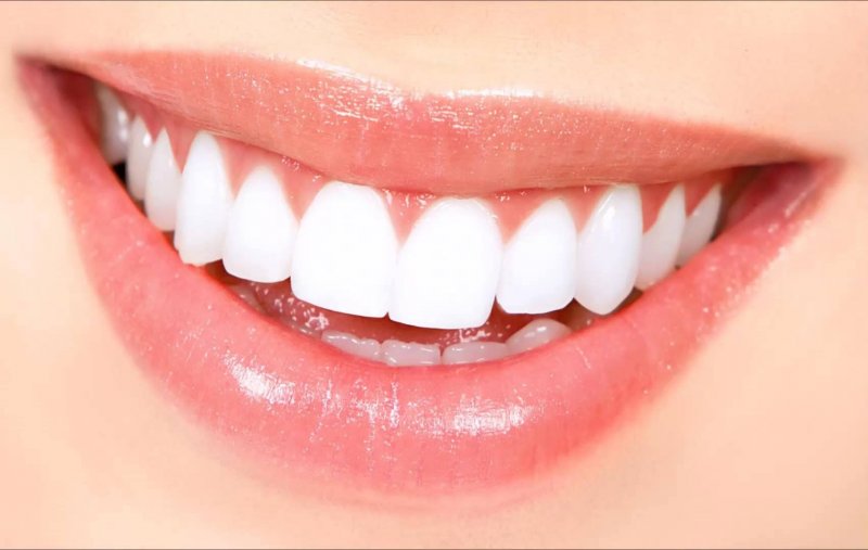 Про преимущества, недостатки виниров