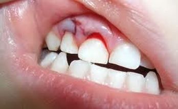 Про травмы зубов