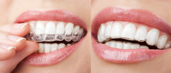 Про каппы Invisalign