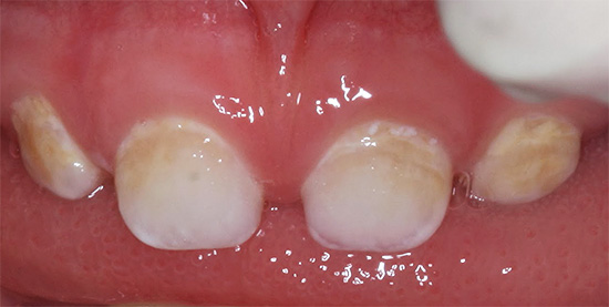 Кариес в молочных зубах