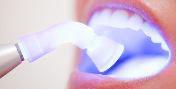 Показания для проведения отбеливания зубов лазером