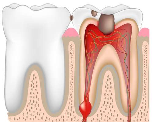 Что такое киста зуба? Что это такое?