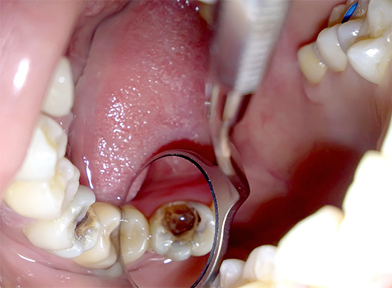 Удаление нерва зуба. Сегодня и вчера