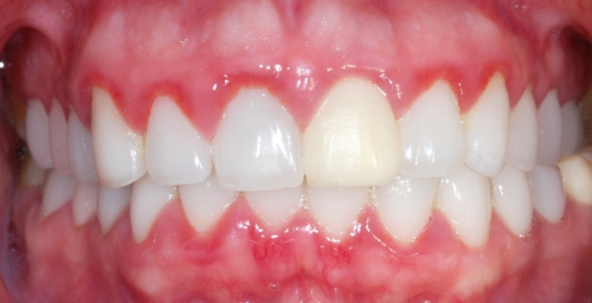 Причины отека десны и методы лечения