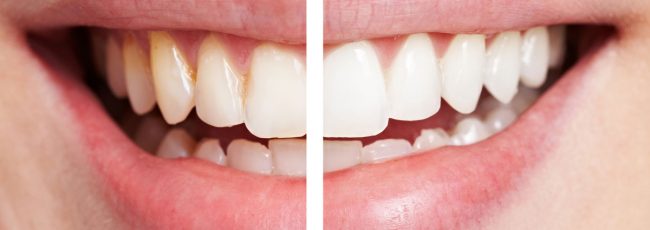 Химическое отбеливание зубов: особенности