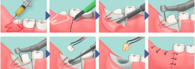 Про удаление зубов мудрости