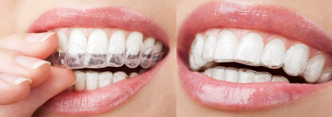 Про каппы Invisalign