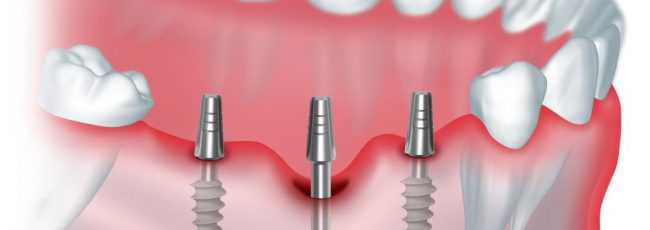 Имплантация - преимущества всех видов протезирования