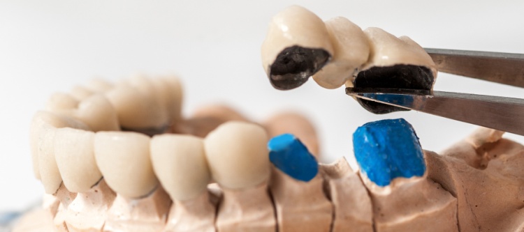 Какие зубы лучше вставить?