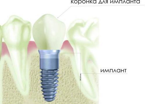 Зубные импланты в эстетической стоматологии