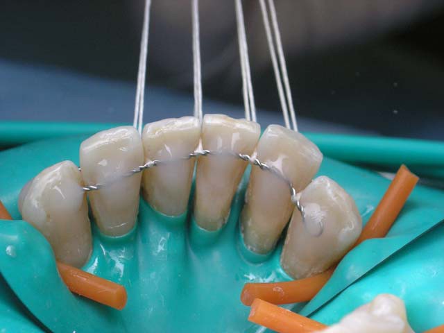 Методы шинирования зубов