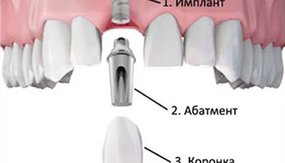 Имплантация верхних зубов