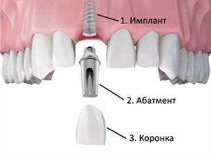 Имплантация верхних зубов