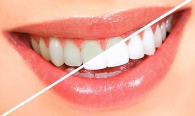 Основные этапы отбеливания зубов