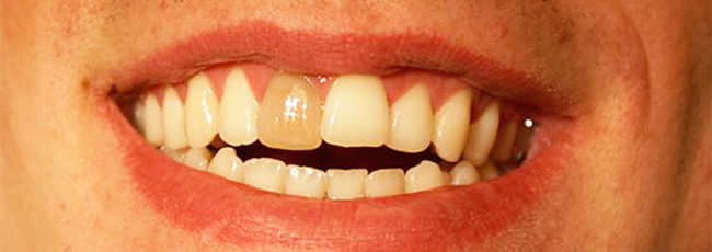 Мертвый зуб в стоматологии