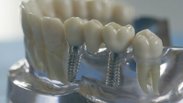 Эстетические проблемы при имплантации зубов