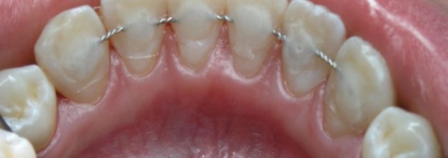 Что такое шинирование зубов?
