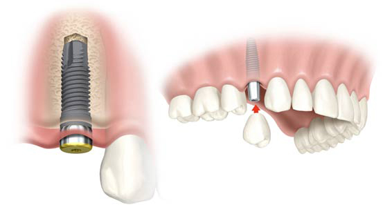 Имплантация зубов в один этап