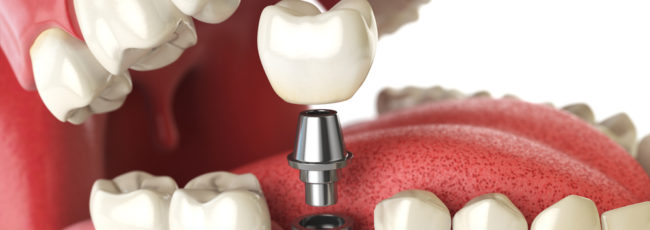 Что делать до операции имплантации зубов?