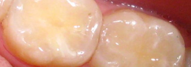 Состав пломбы в стоматологии