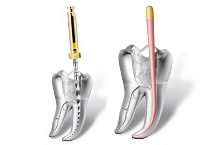 Что делать после лечения корневых каналов?