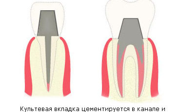Культевые вкладки в стоматологии