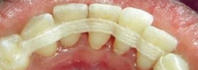 Преимущества и недостатки шинирования зубов