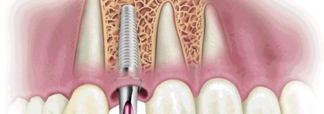 Осложнения имплантации зубов