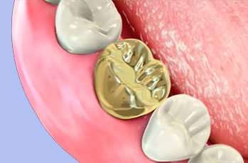 Золотые коронки в стоматологии